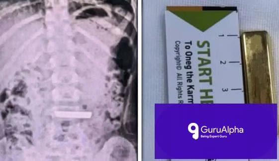 چین میں 5 سالہ بچی نے 50 گرام کا سونے کا بسکٹ نگل لیا: طبی ماہرین کی بروقت کارروائی
