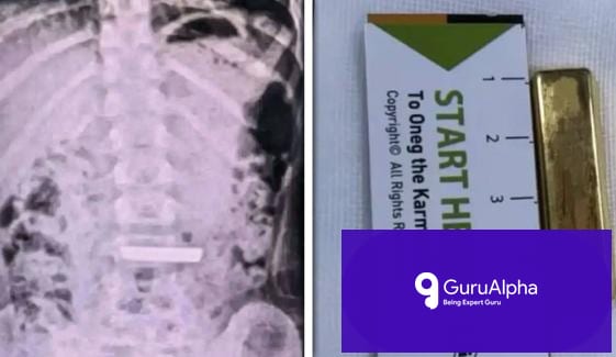 چین میں 5 سالہ بچی نے 50 گرام کا سونے کا بسکٹ نگل لیا: طبی ماہرین کی بروقت کارروائی